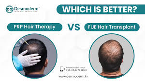 PRP vs FUE Hair Transplant: Which Is Better for Hair Loss?